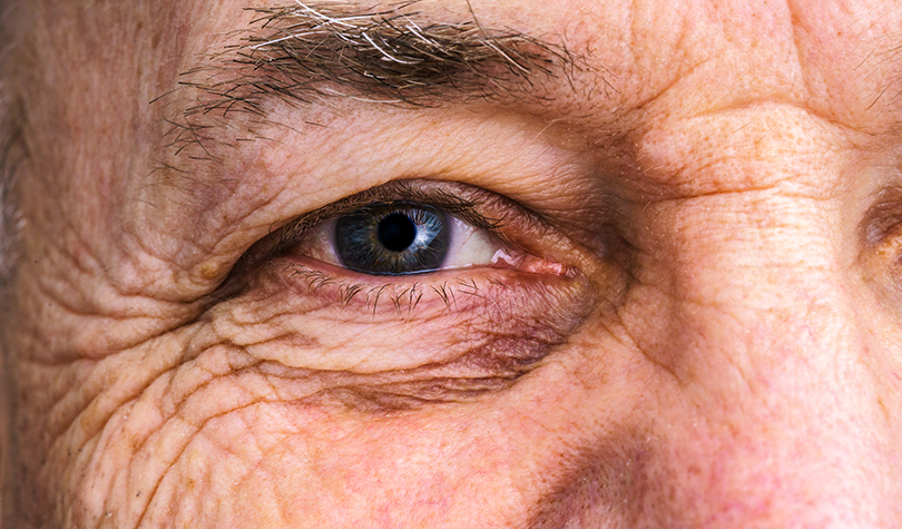 La cataracte : le vieillissement naturel de l'œil